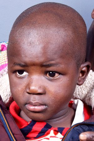 Kenyan child receives life-saving canacer treatment through Operation Eyesight.
